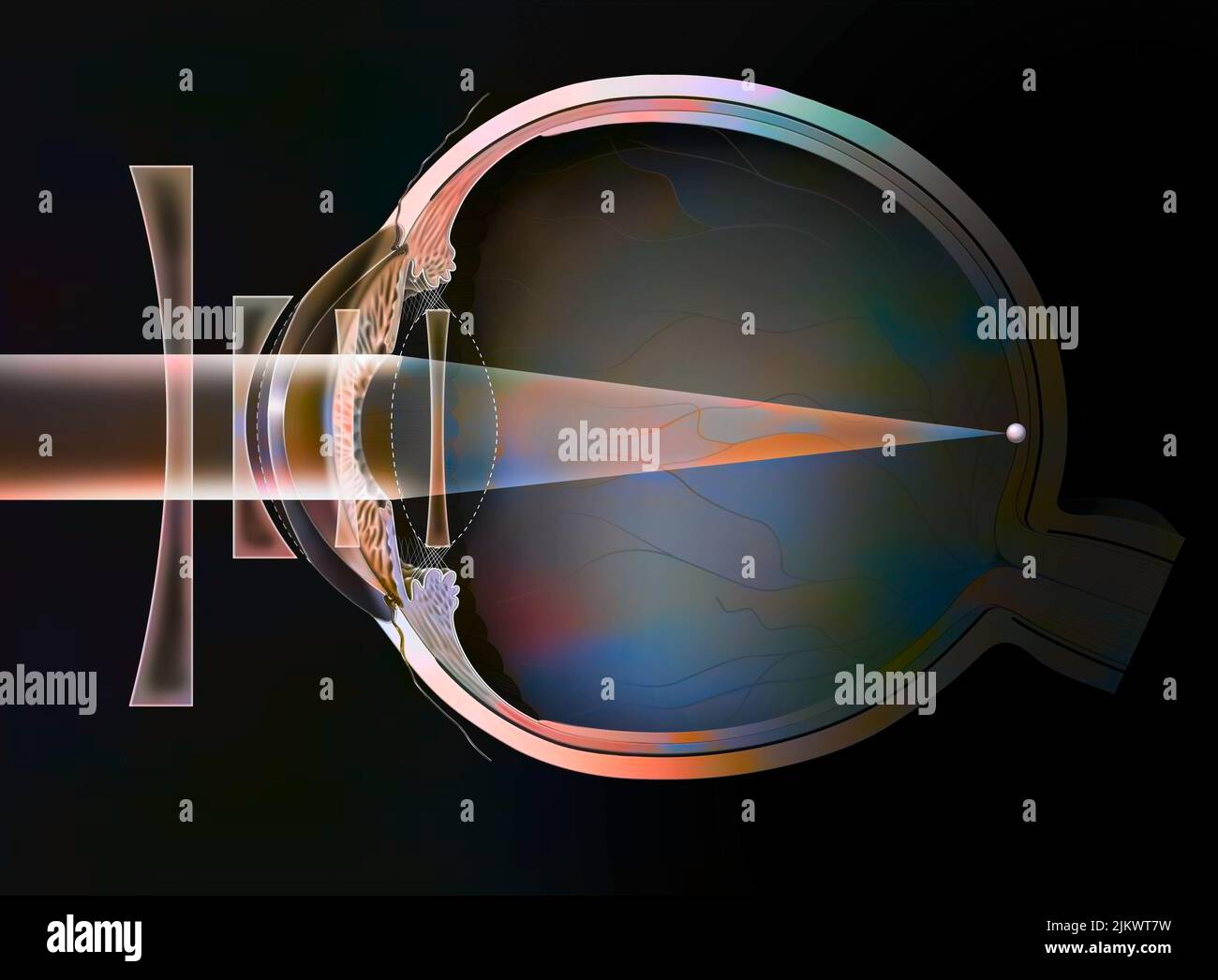 Différentes corrections possibles d'un œil myope: Verres de lunettes - lentilles externes. Banque D'Images