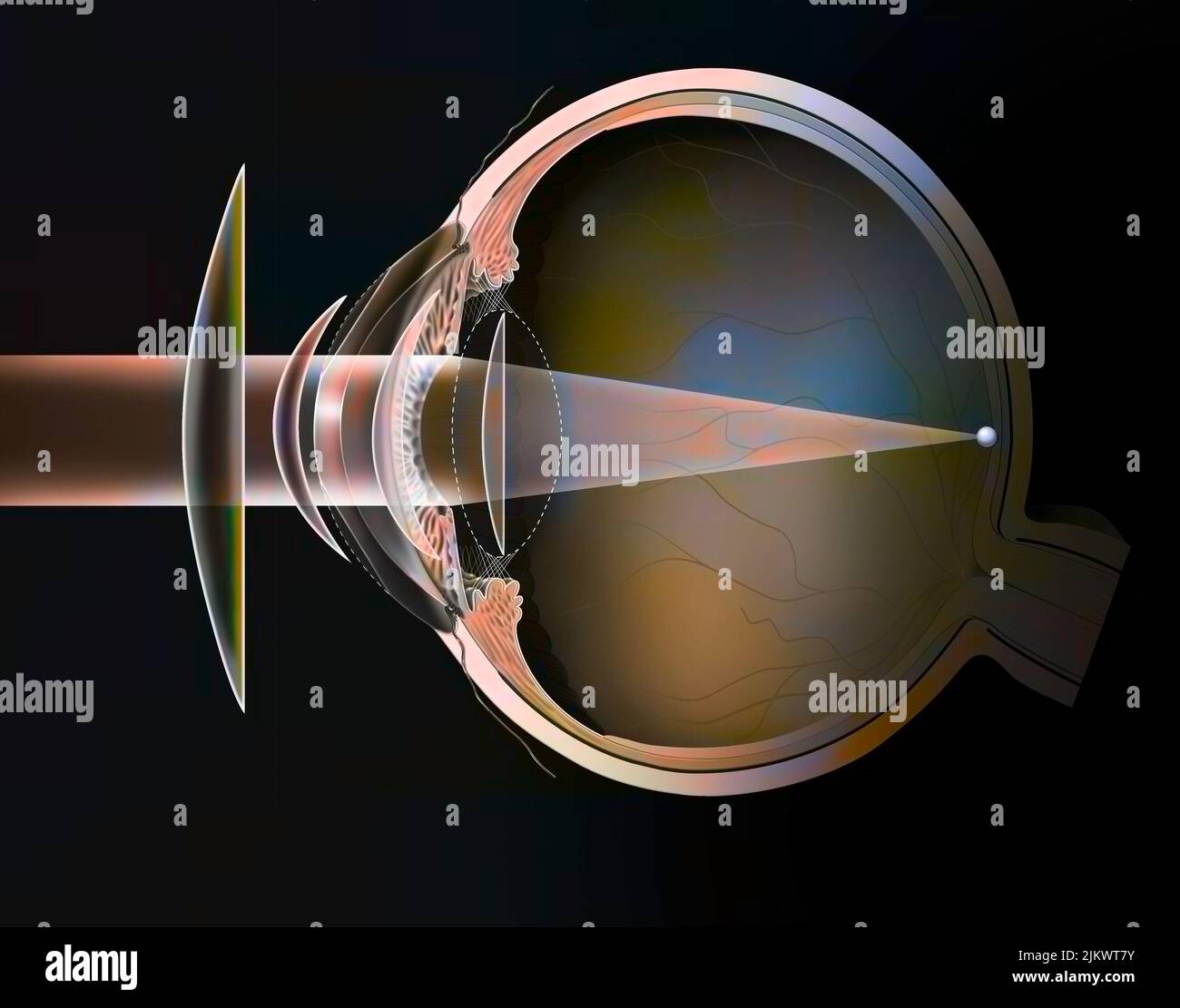 Différentes corrections possibles d'un œil hypertopique: Verres de lunettes - lentilles externes. Banque D'Images