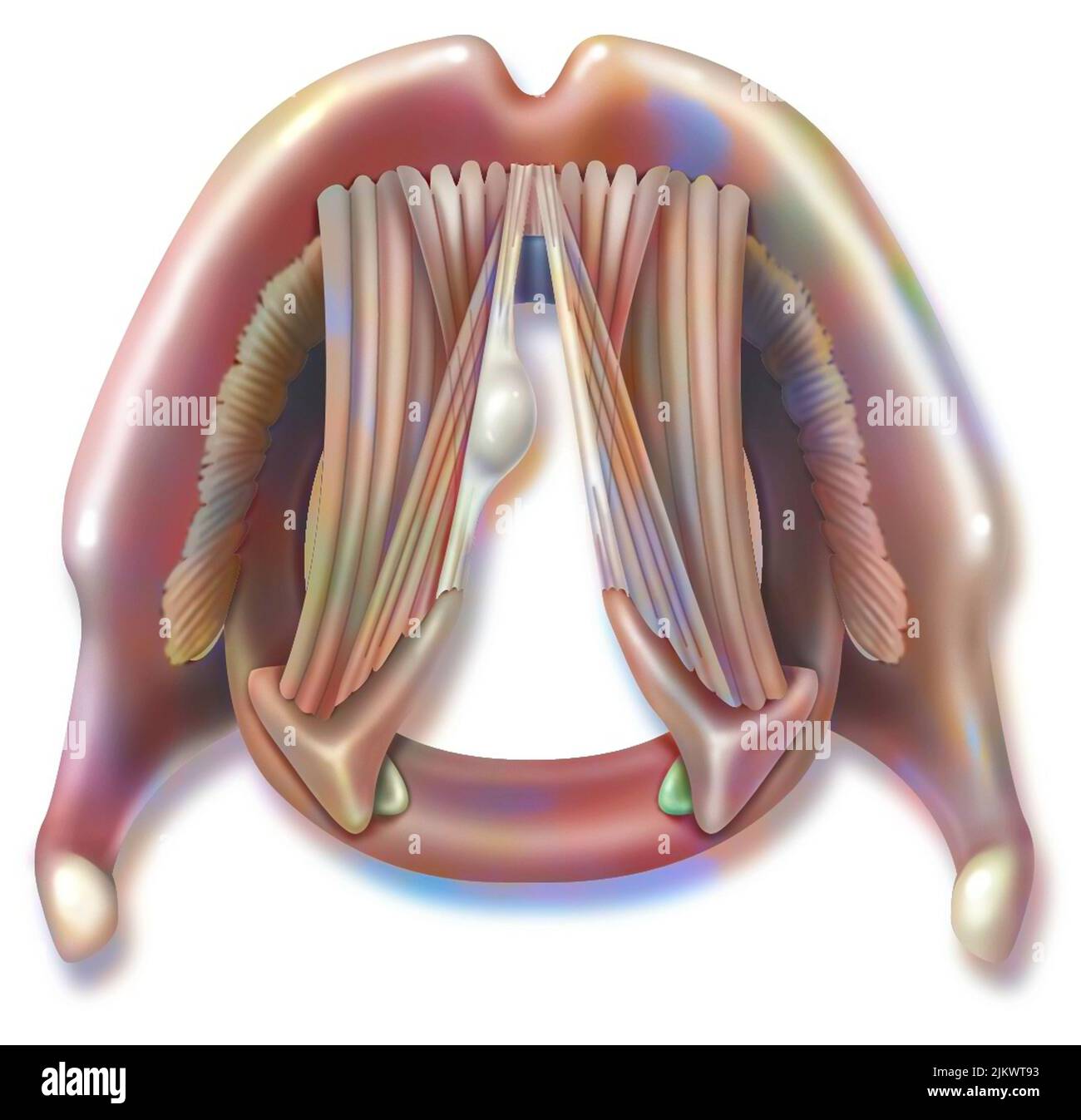 Polype sur une corde vocale avec muscles thyro-aryténoïdes. Banque D'Images