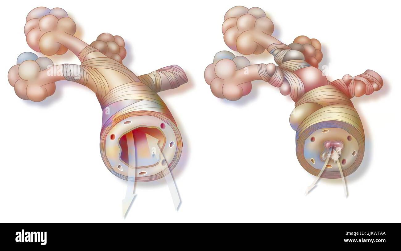 Asthme : bronchiole sain (à gauche) et asthmatique (à droite). Banque D'Images
