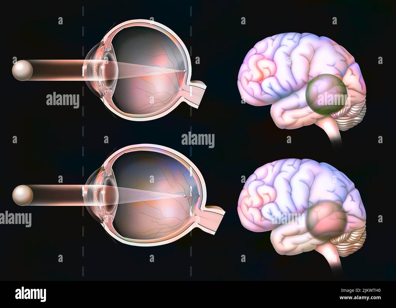 Comparaison entre la vision normale et celle d'un œil myope. Banque D'Images