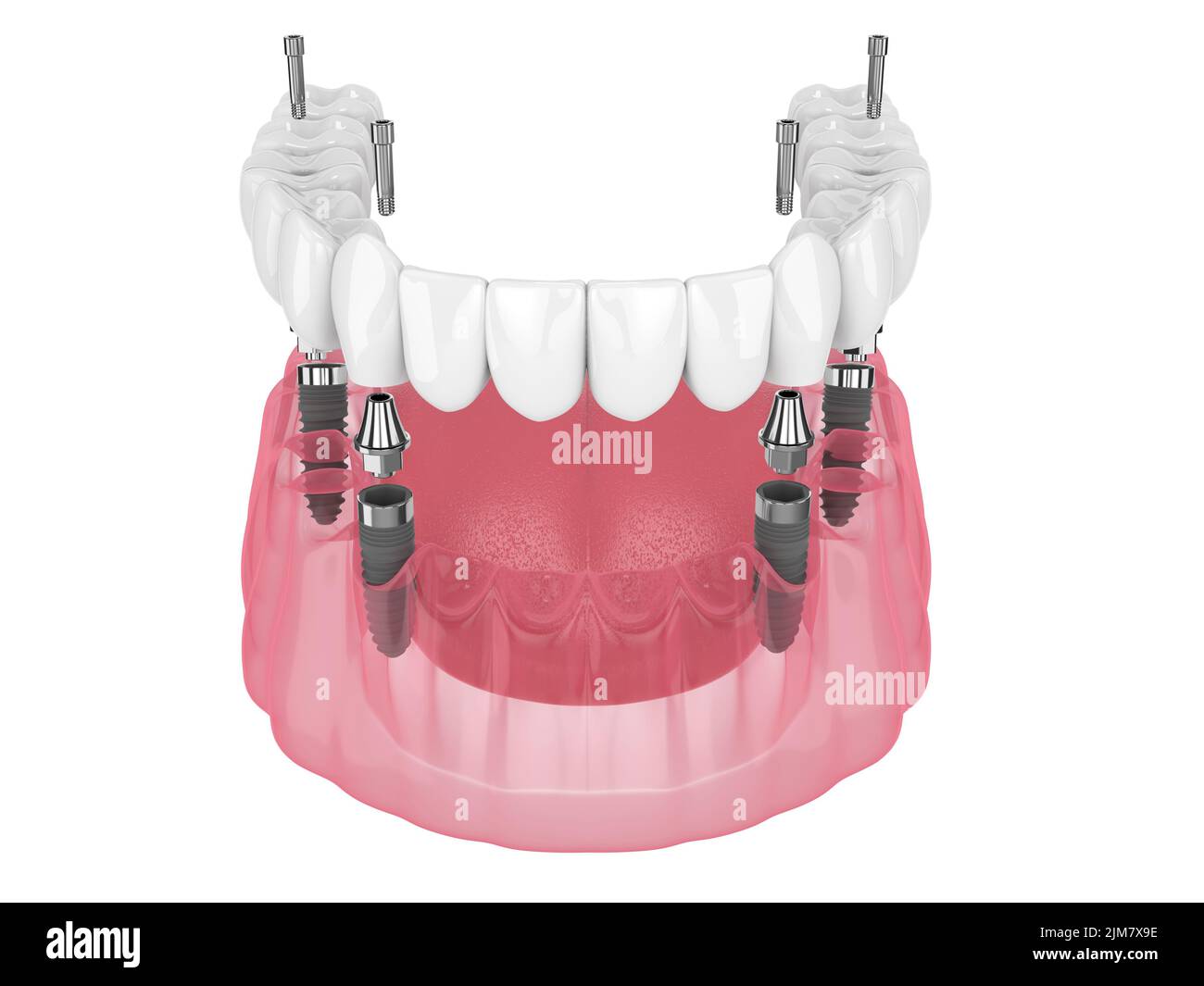 Prothèse mandibulaire, système All On 4 supporté par des implants sur fond blanc Banque D'Images