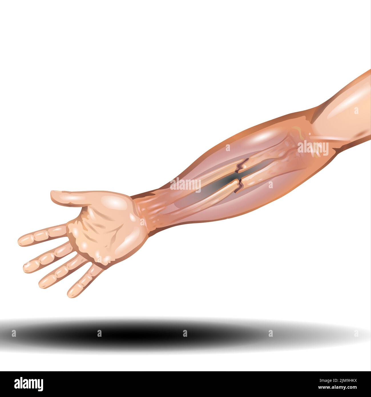 Fracture de l'os de la main - fracture du rayon distal et fracture du bras types d'os anatomie - Illustration vectorielle sur fond blanc Banque D'Images