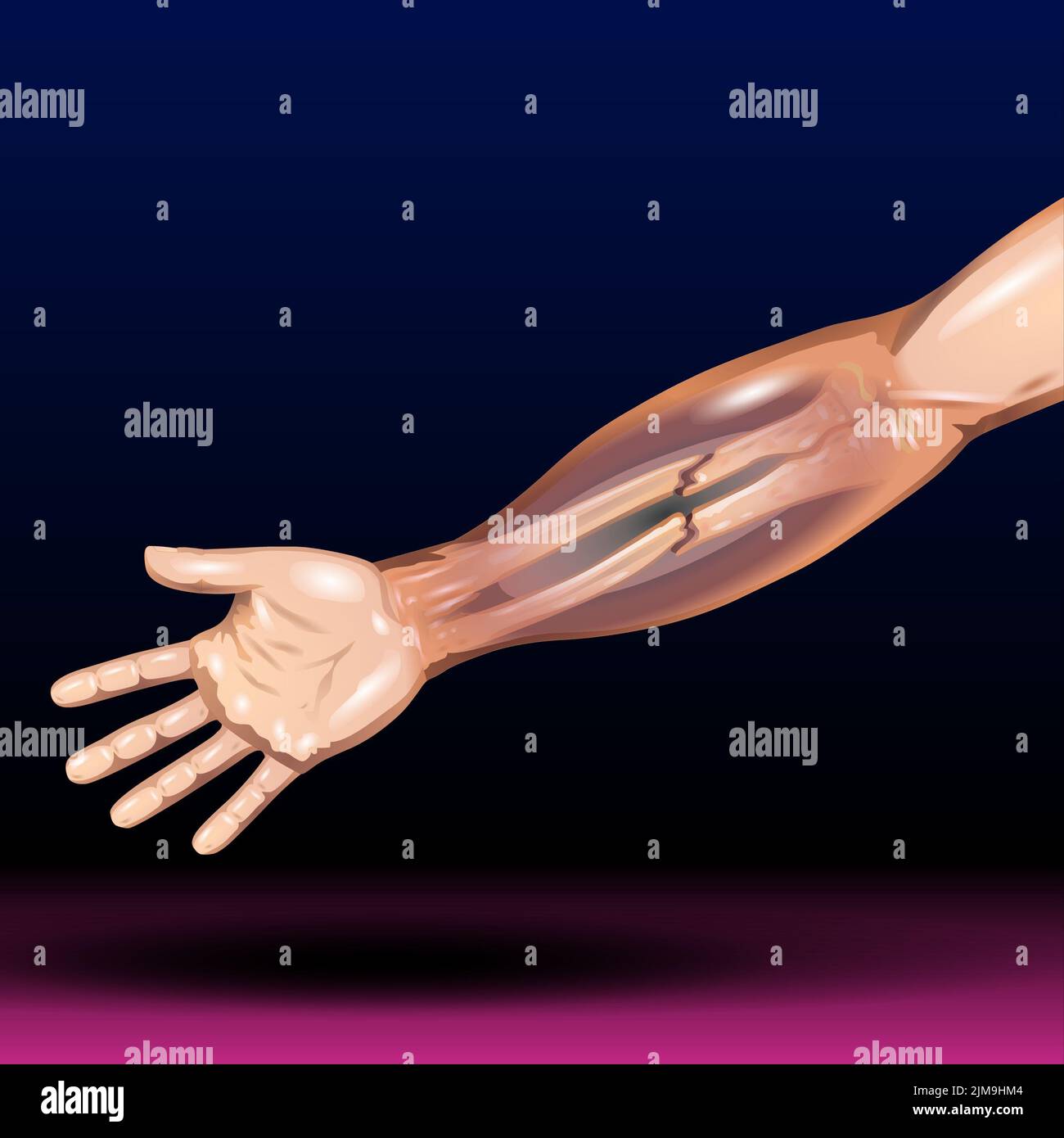Fracture de l'os de la main - fracture du rayon distal et fracture du bras types d'os - Illustration vectorielle Banque D'Images