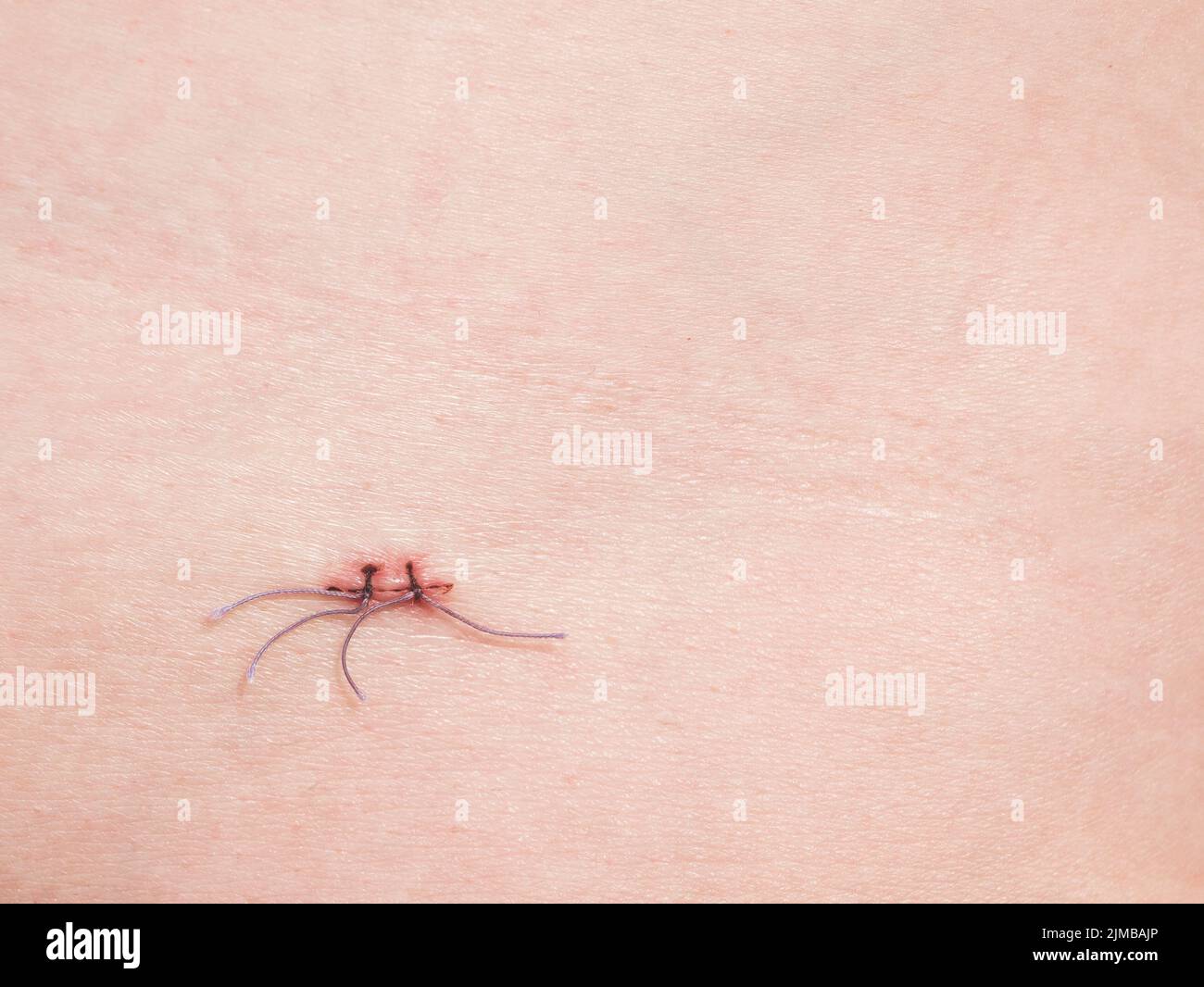 Suture non absorbable sur la peau, espace de copie. Des points de suture peu soigneux pour fermer la plaie, gros plan Banque D'Images
