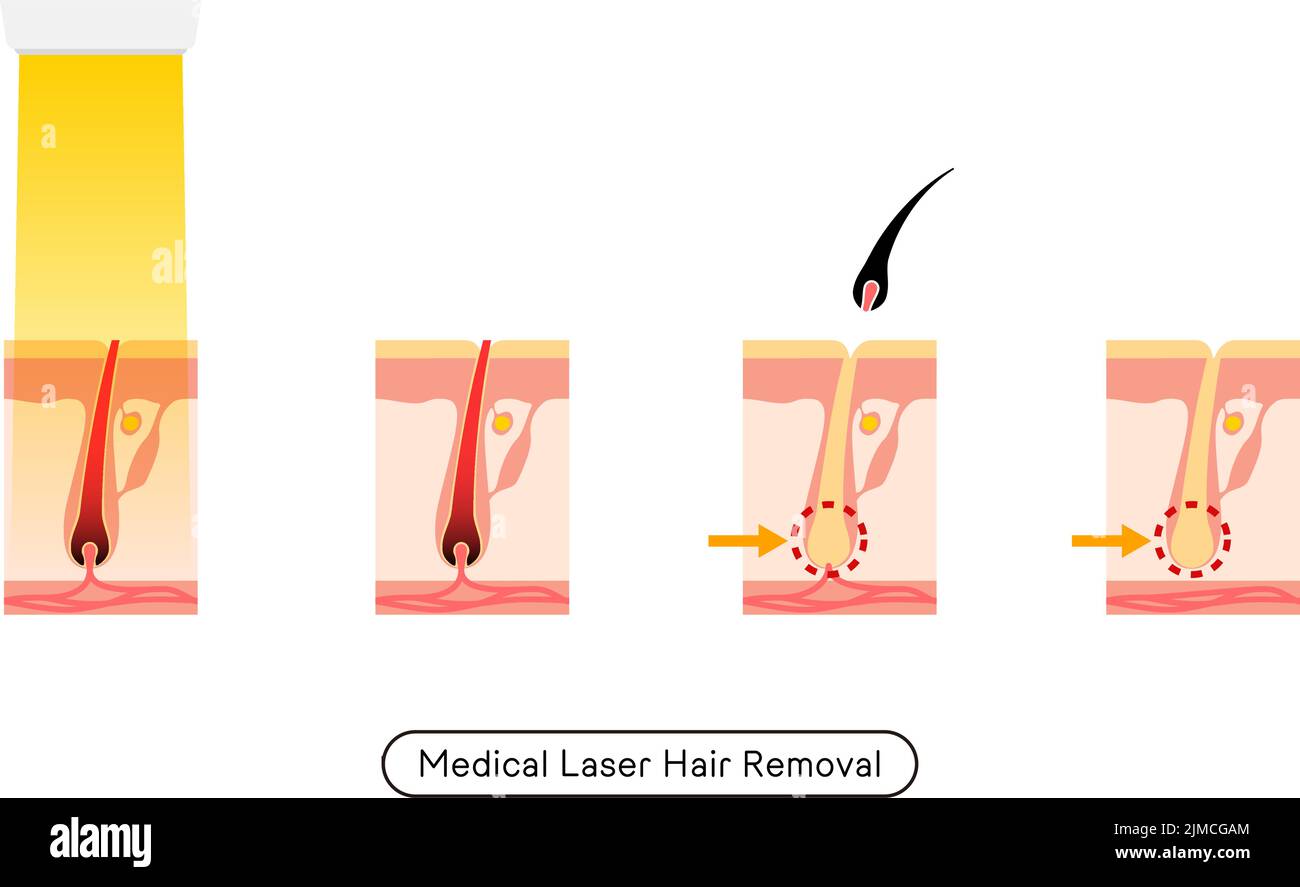 Image de l'enlèvement de cheveux, le processus de l'enlèvement de cheveux après le traitement médical d'enlèvement de cheveux de laser Illustration de Vecteur