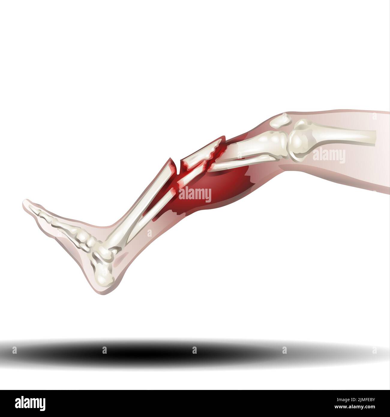 Fracture osseuse de la jambe - Illustration sur fond blanc Banque D'Images