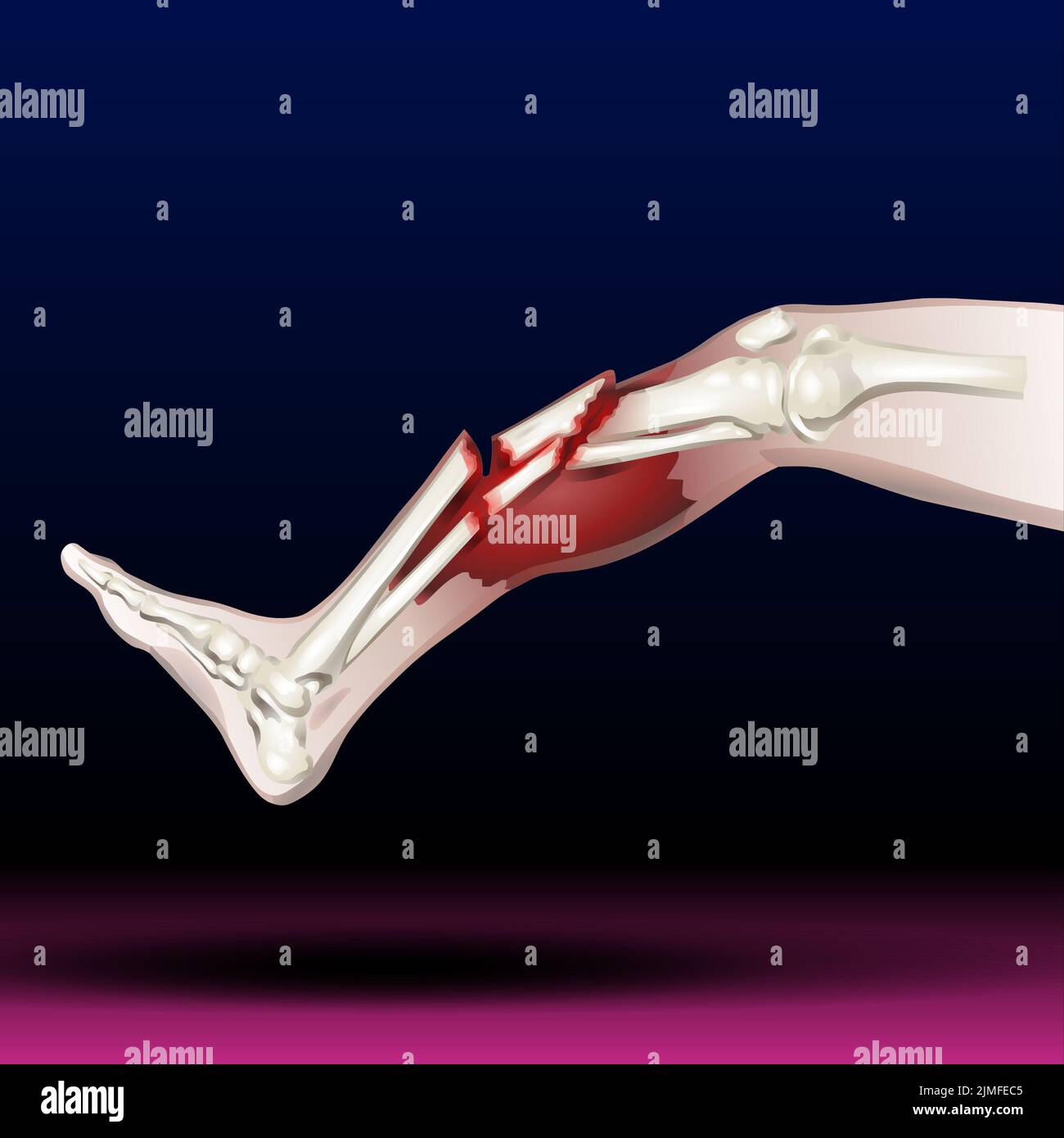 Fracture osseuse de la jambe - Illustration Banque D'Images