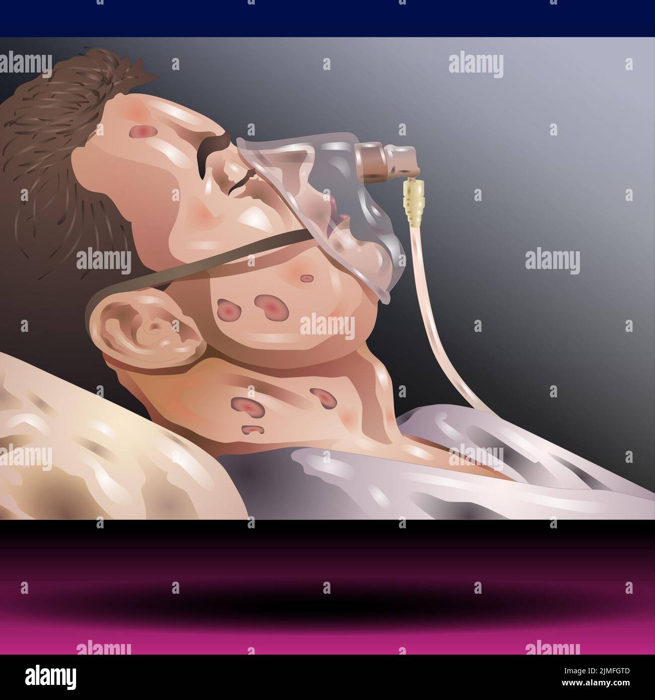Patient avec masque d'oxygène - patient masculin à l'hôpital ayant une ventilation pulmonaire artificielle étant dans un état critique allongé sur le lit avec un vecteur de masque Banque D'Images