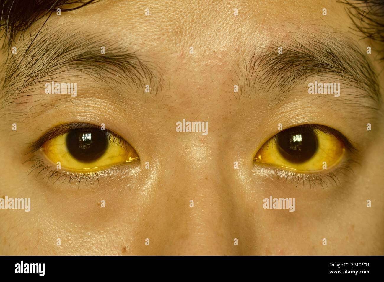 Jaunisse profonde chez le patient asiatique mâle. Décoloration jaunâtre de la peau et de la sclère. Hyperbilirubinémie. Hépatite aiguë. Banque D'Images