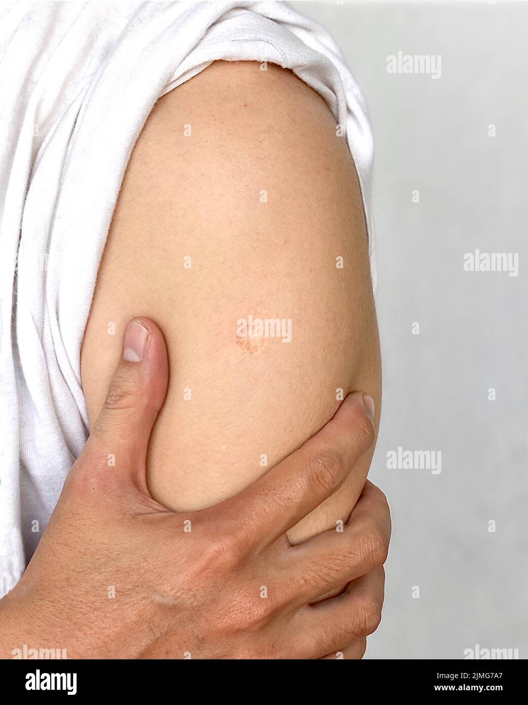 Le BCG ou la marque de cicatrice du vaccin antituberculeux au bras de  l'homme de l'Asie du Sud-est Photo Stock - Alamy