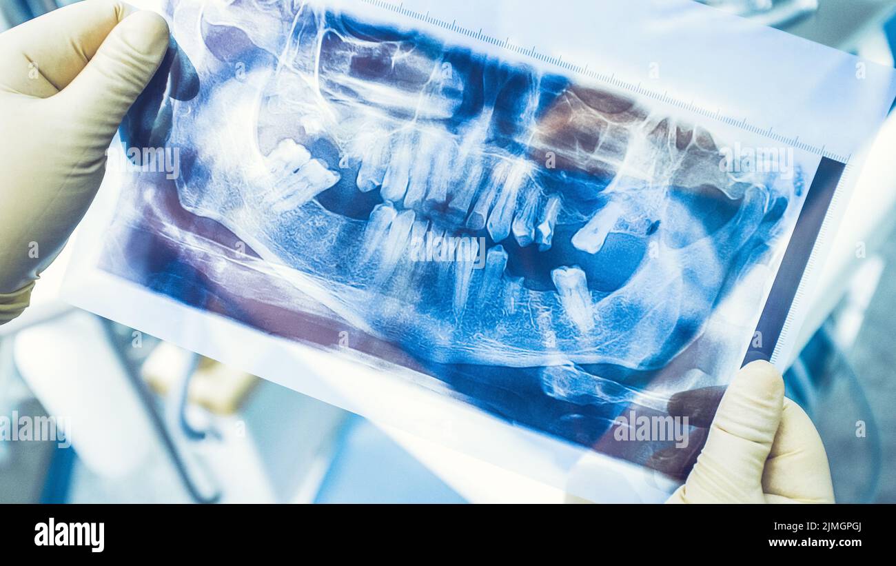 radiographie panoramique de la chirurgie dentaire par implant thérapeutique Banque D'Images