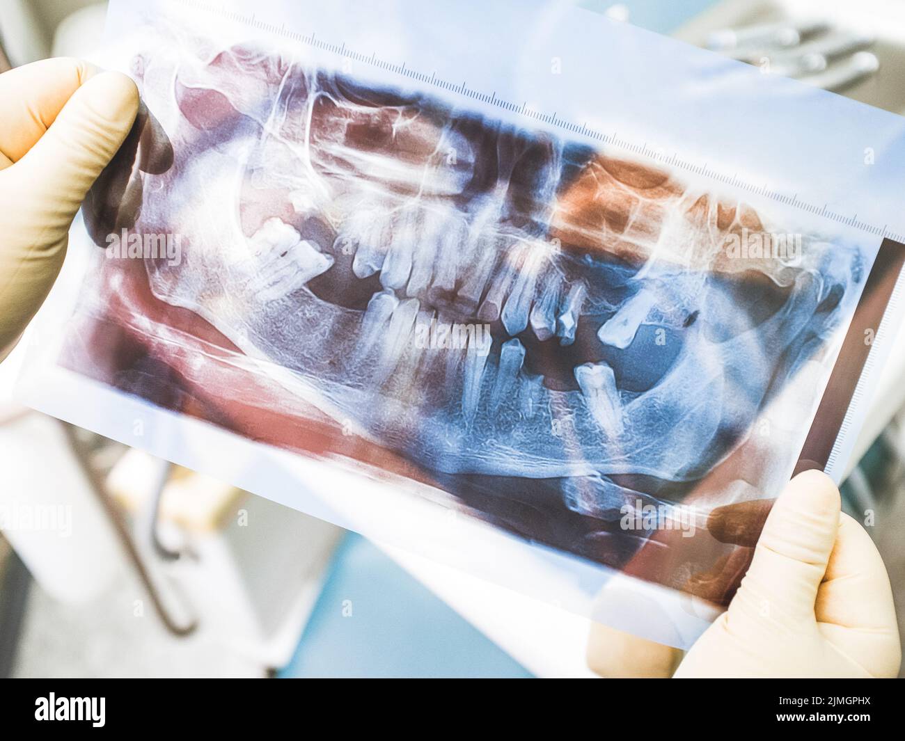 implant dentaire thérapie agomphiasis panoramique rayons x. Banque D'Images