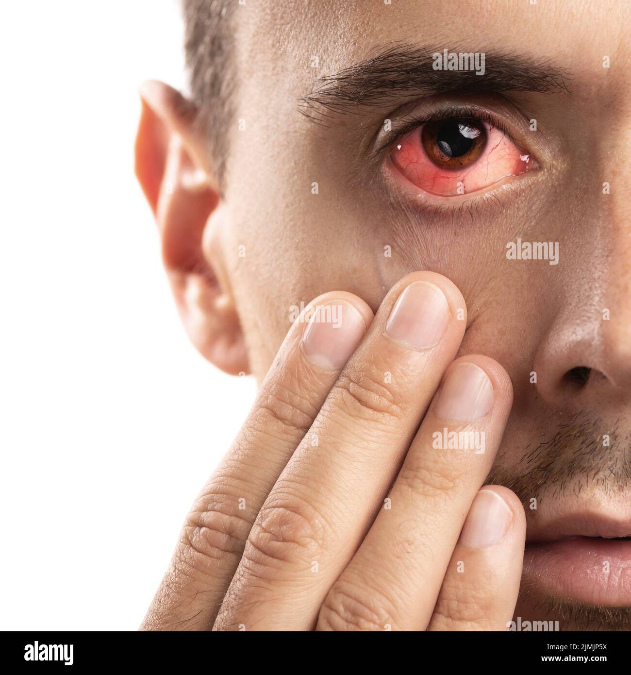 Homme Avec Lhémorragie Sous Conjonctivale Dans Son œil Photo Stock Alamy