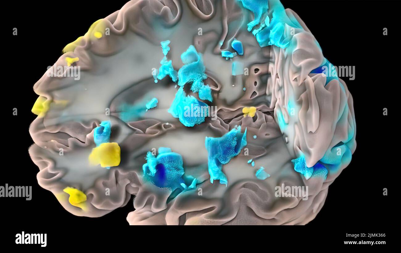 3D médical 3D illustration de l'activité neuronale du cerveau humain Banque D'Images