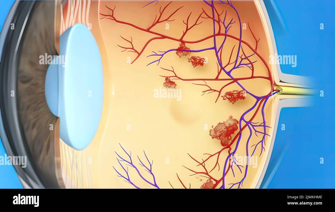 Edema eye Banque de photographies et d’images à haute résolution - Alamy
