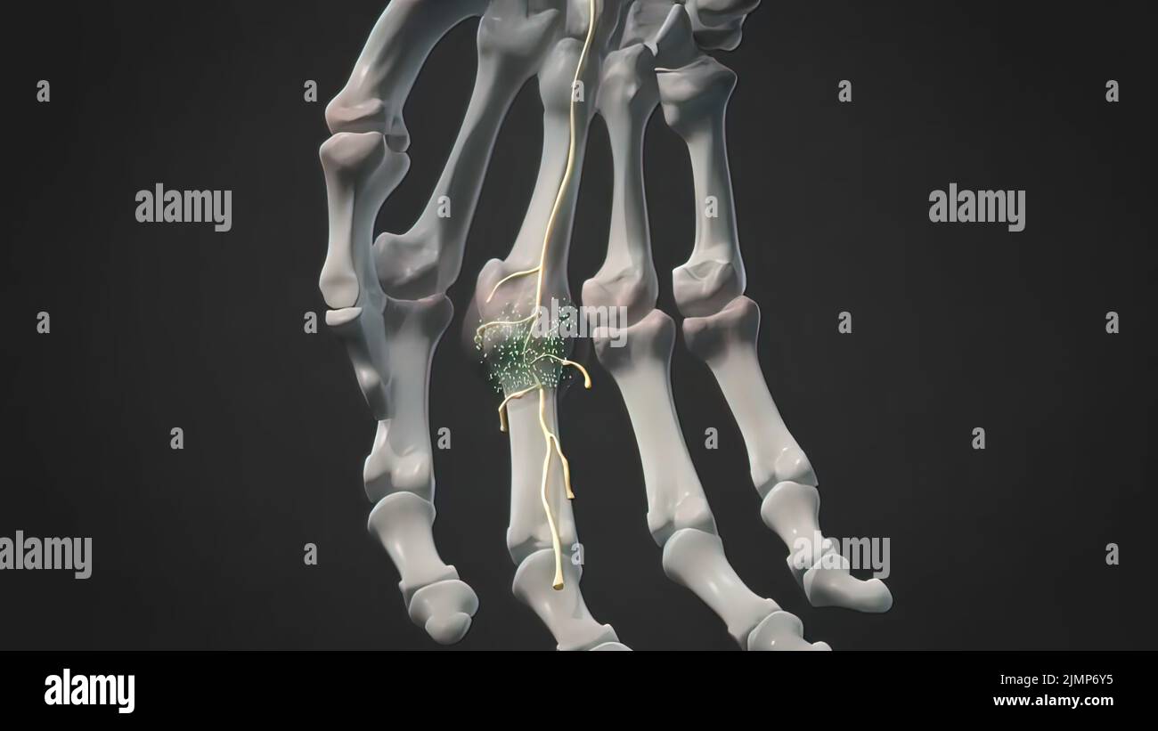 Articulations des doigts gonflées et enflammées Photo Stock Alamy