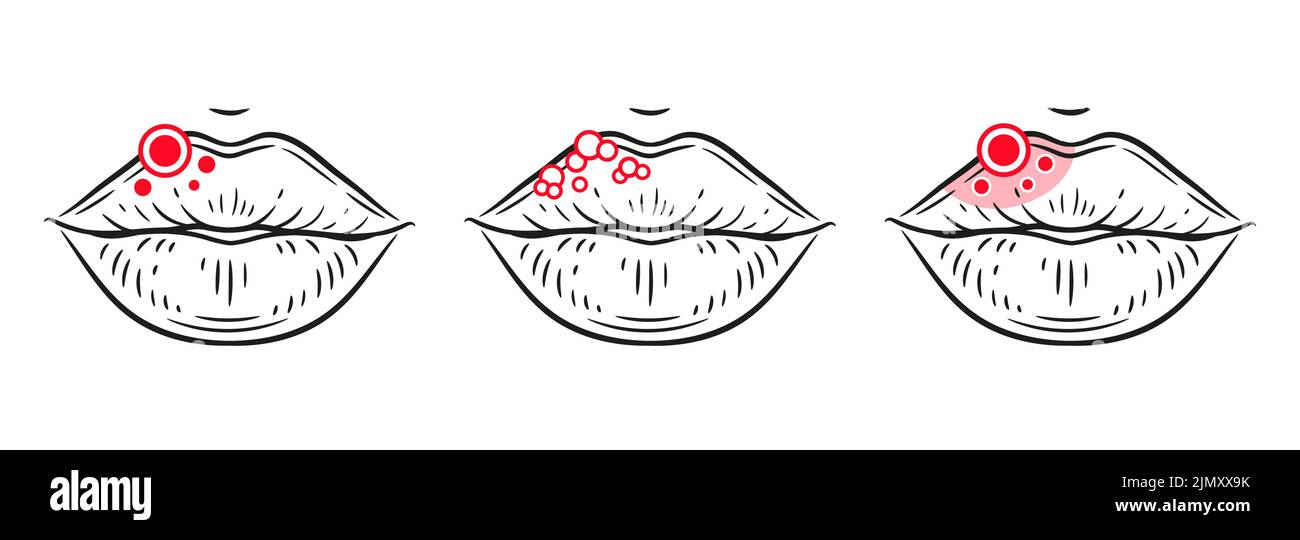 Herpès virus éruption sur les lèvres, plaie, inflammation peau visage, stomatite bouche icône. Blister, ulcère, acné, réaction d'allergie faciale. Infection orale. Vecteur Illustration de Vecteur