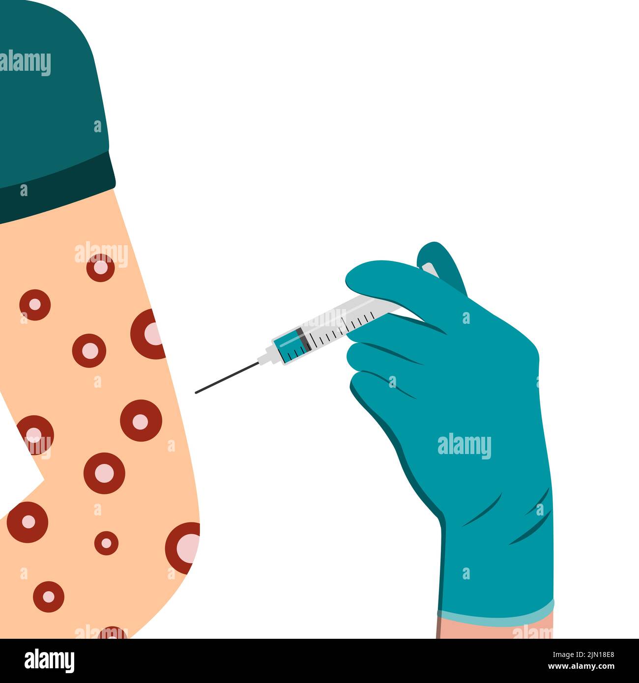 Vaccination contre le virus de la varicelle dans l'épaule et le bras avec une seringue. Éruption sur le corps. Symptômes de la maladie du virus de la pox du singe sur les mains éruptions cutanées Illustration de Vecteur