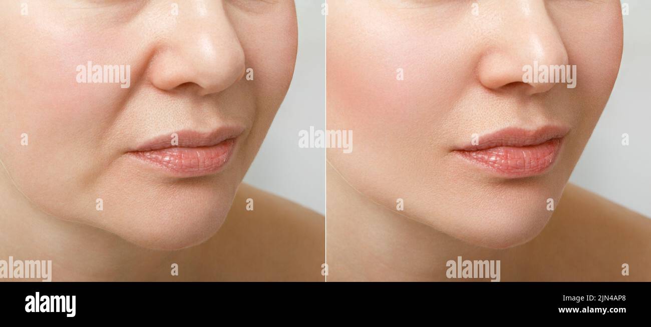 Un portrait rapproché d'une femme âgée avant et après la procédure de lifting. Le résultat du rajeunissement du visage et du lissage des rides dans une cosmétologie Banque D'Images