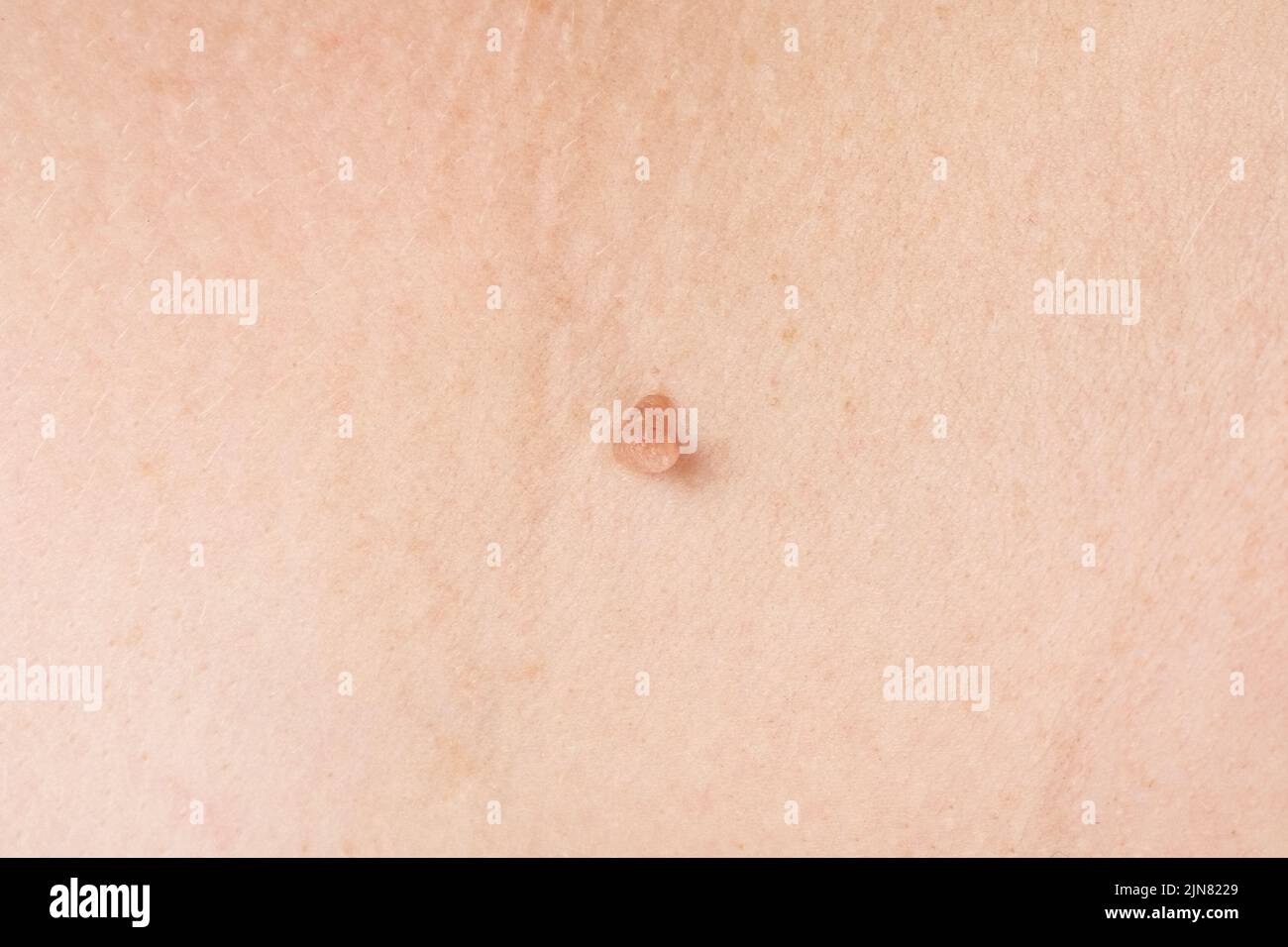 Cancer papillome sur la peau verrue de près. Banque D'Images