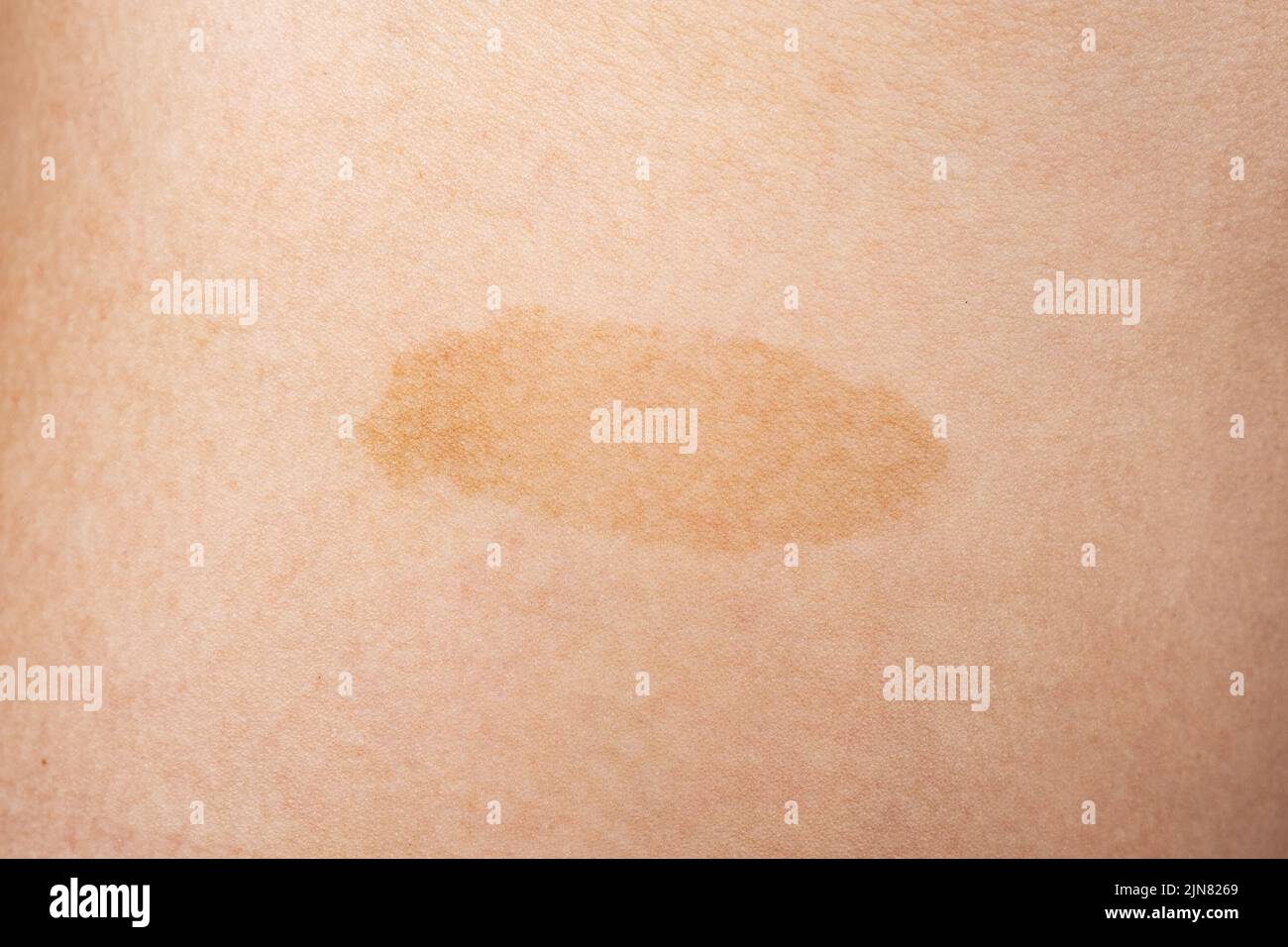 cancer de la peau gros plan, marque de naissance jaune sur la peau. Banque D'Images