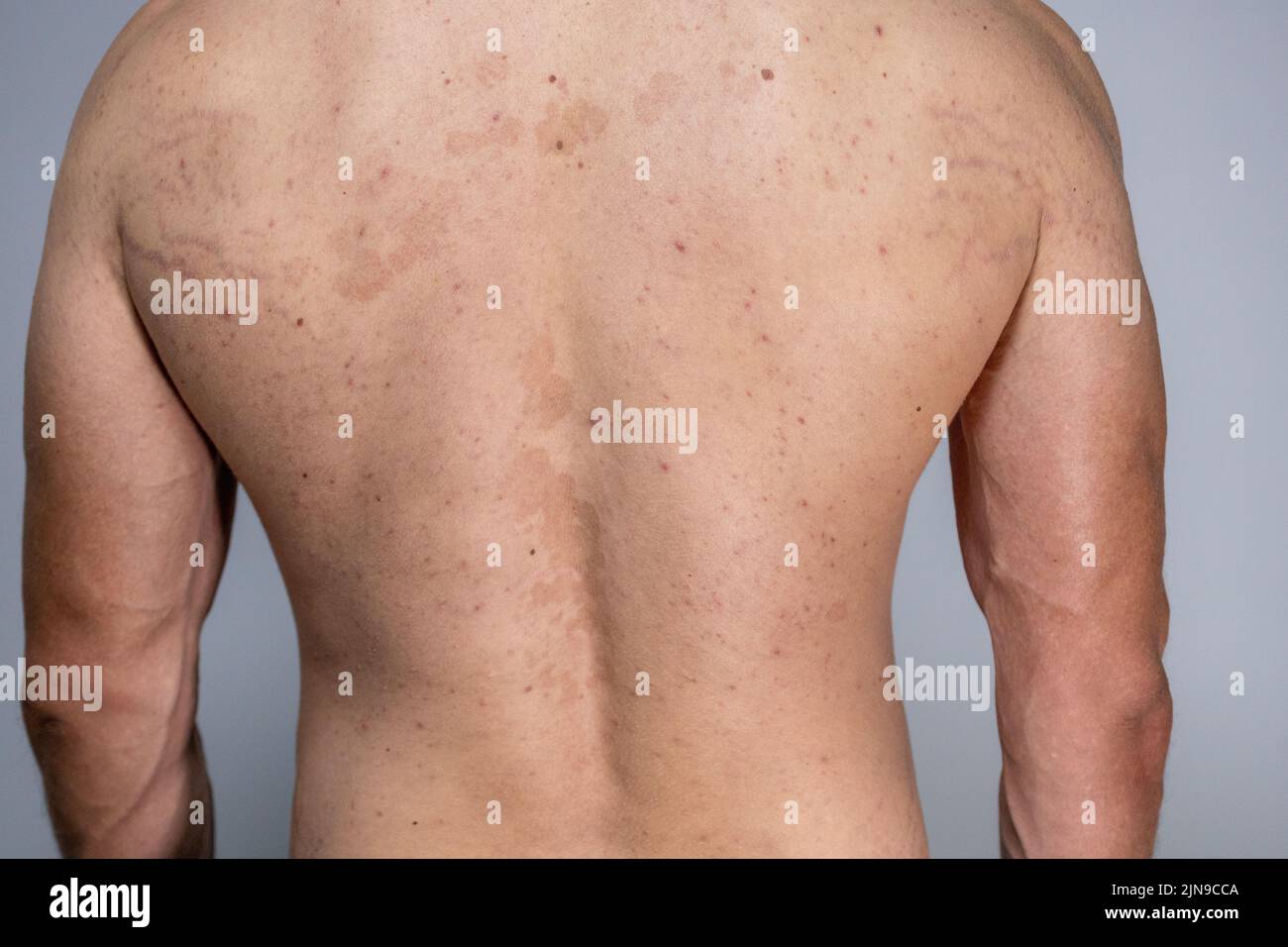 tinea versicolor sur le dos. pityriasis versicolor problème avec la