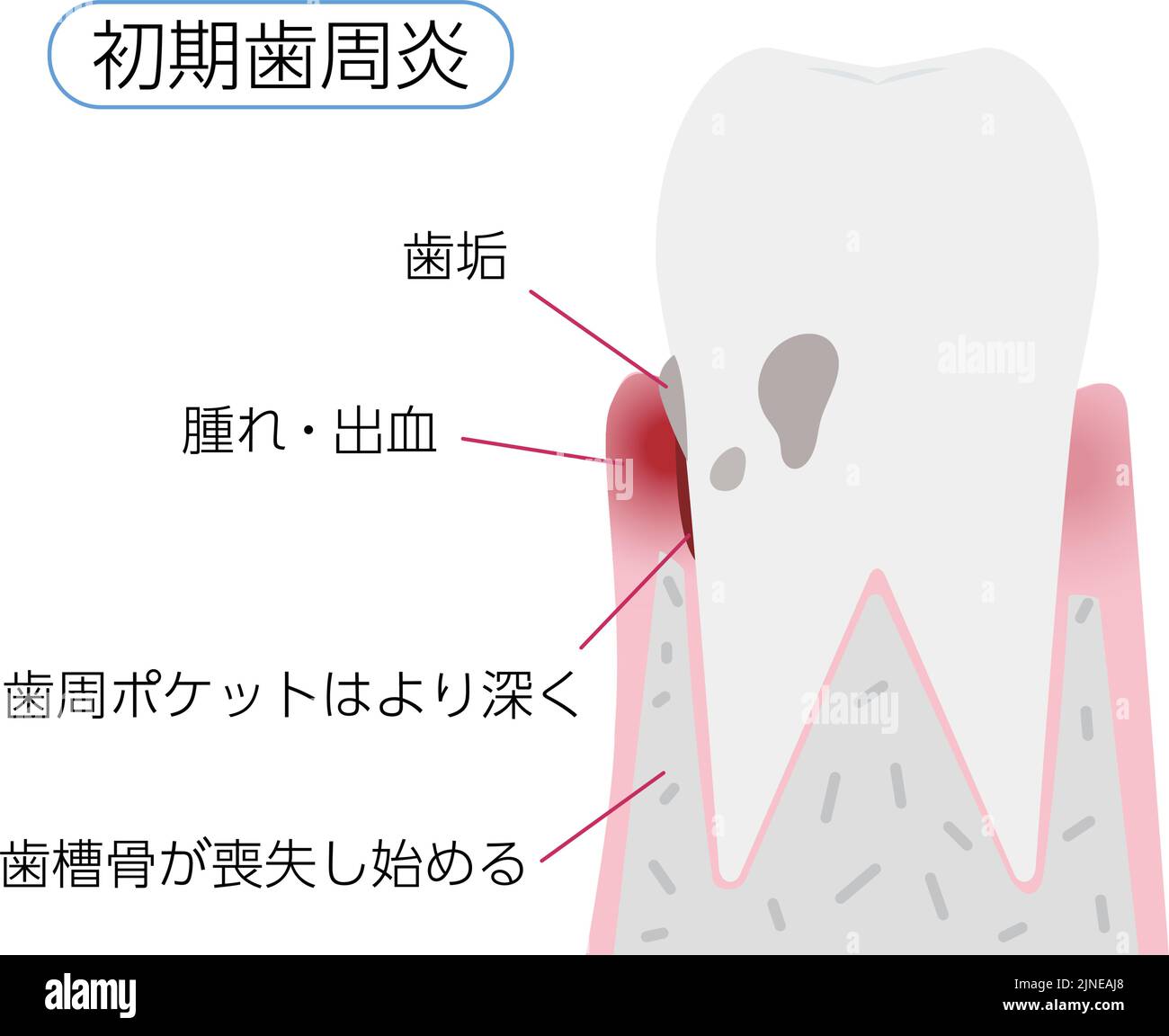 Illustration par étape de la maladie parodontale: Parodontite précoce Traduction: Parodontite précoce, plaque, gonflement / saignement, po parodontale profonde Illustration de Vecteur