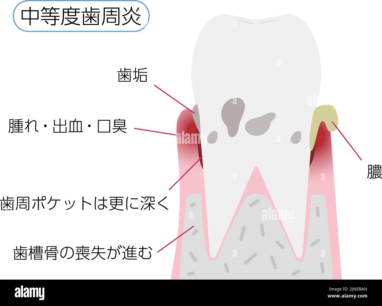 Illustration par étape de la maladie parodontale: Parodontite modérée Traduction: Parodontite modérée, plaque, gonflement / saignement / mauvaise haleine, de Illustration de Vecteur