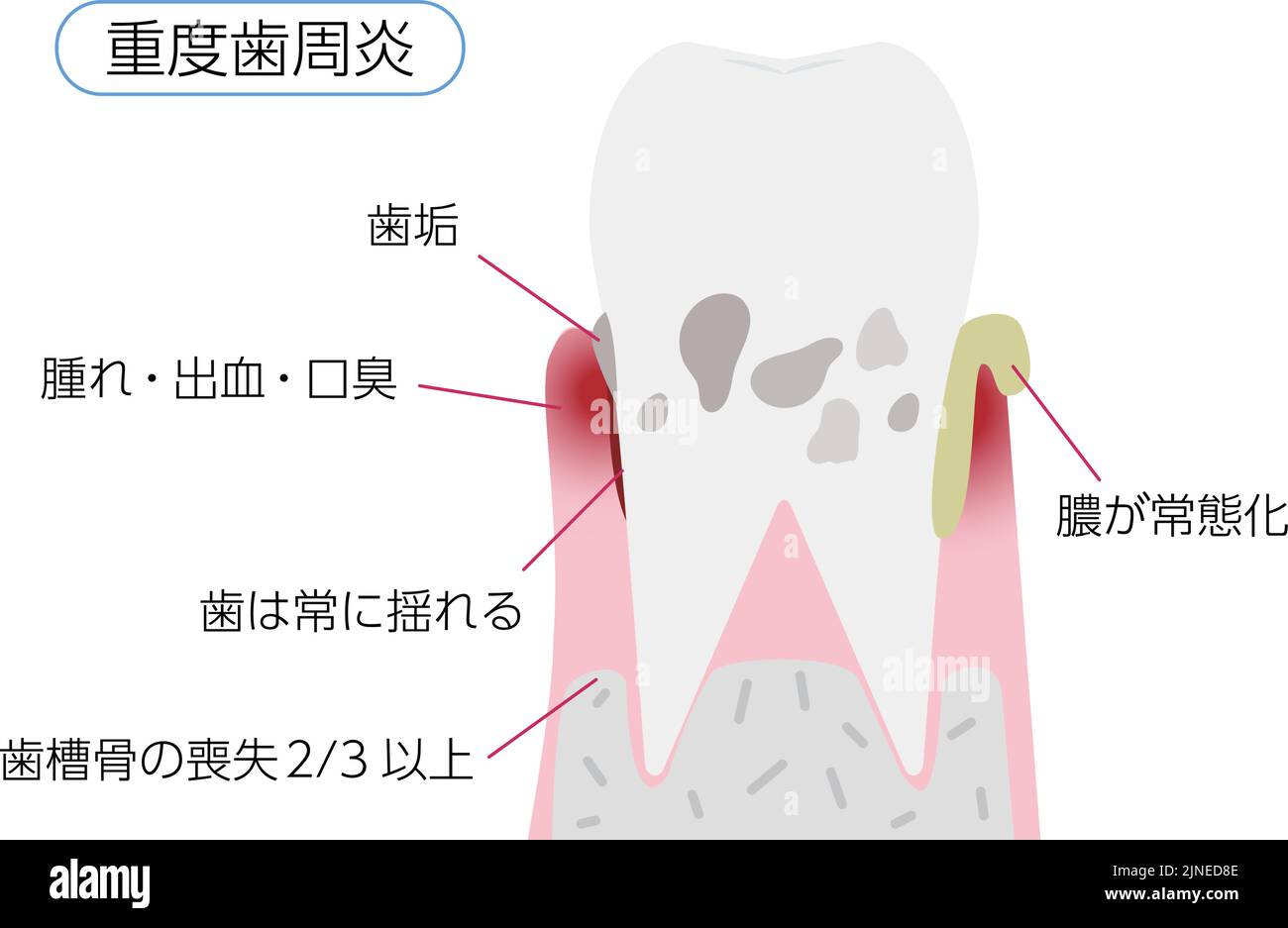 Illustration par étape de la maladie parodontale: Parodontite sévère Traduction: Parodontite sévère, plaque, gonflement / saignement / mauvaise haleine, dents Illustration de Vecteur