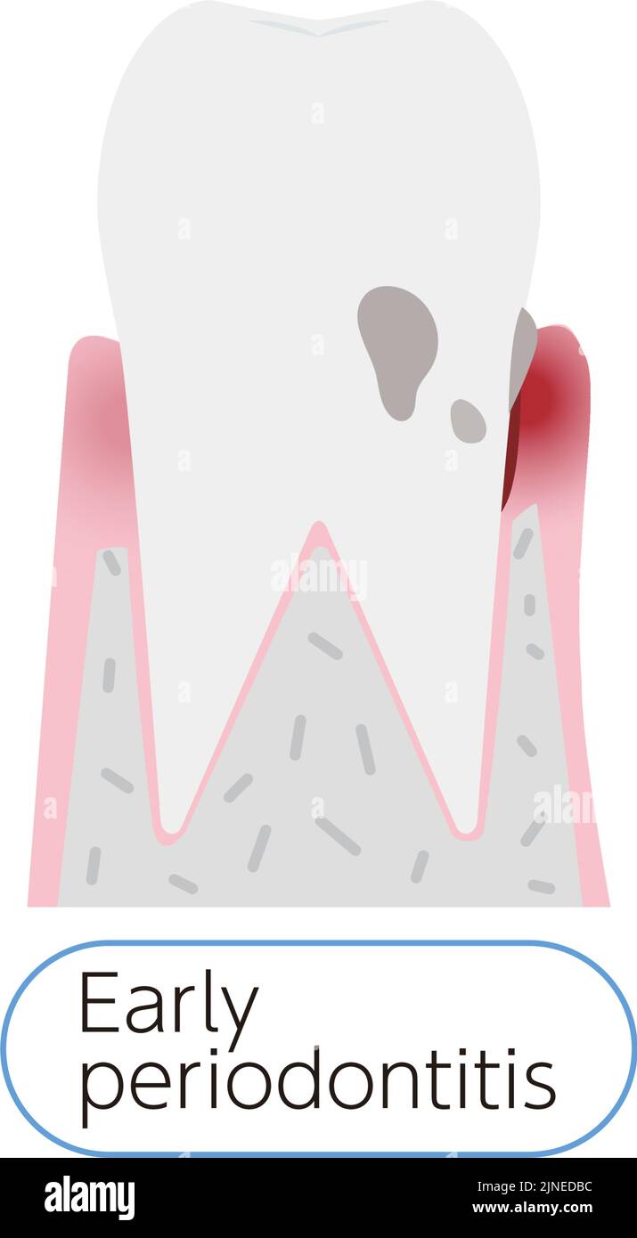 Illustration par étape de la maladie parodontale : parodontite précoce Illustration de Vecteur