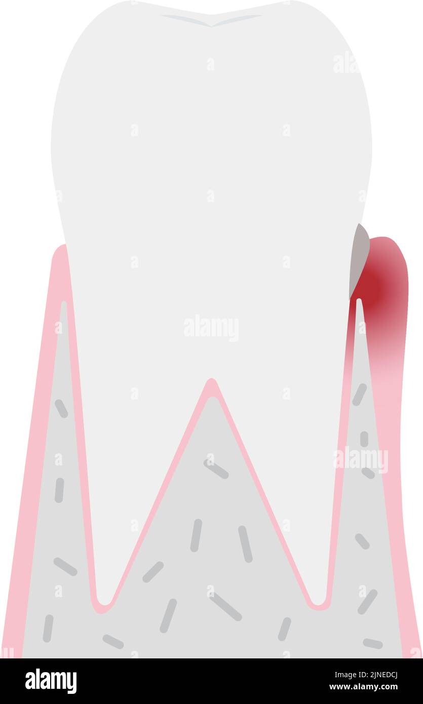 Illustration par stade de la maladie parodontale : gingivite Illustration de Vecteur