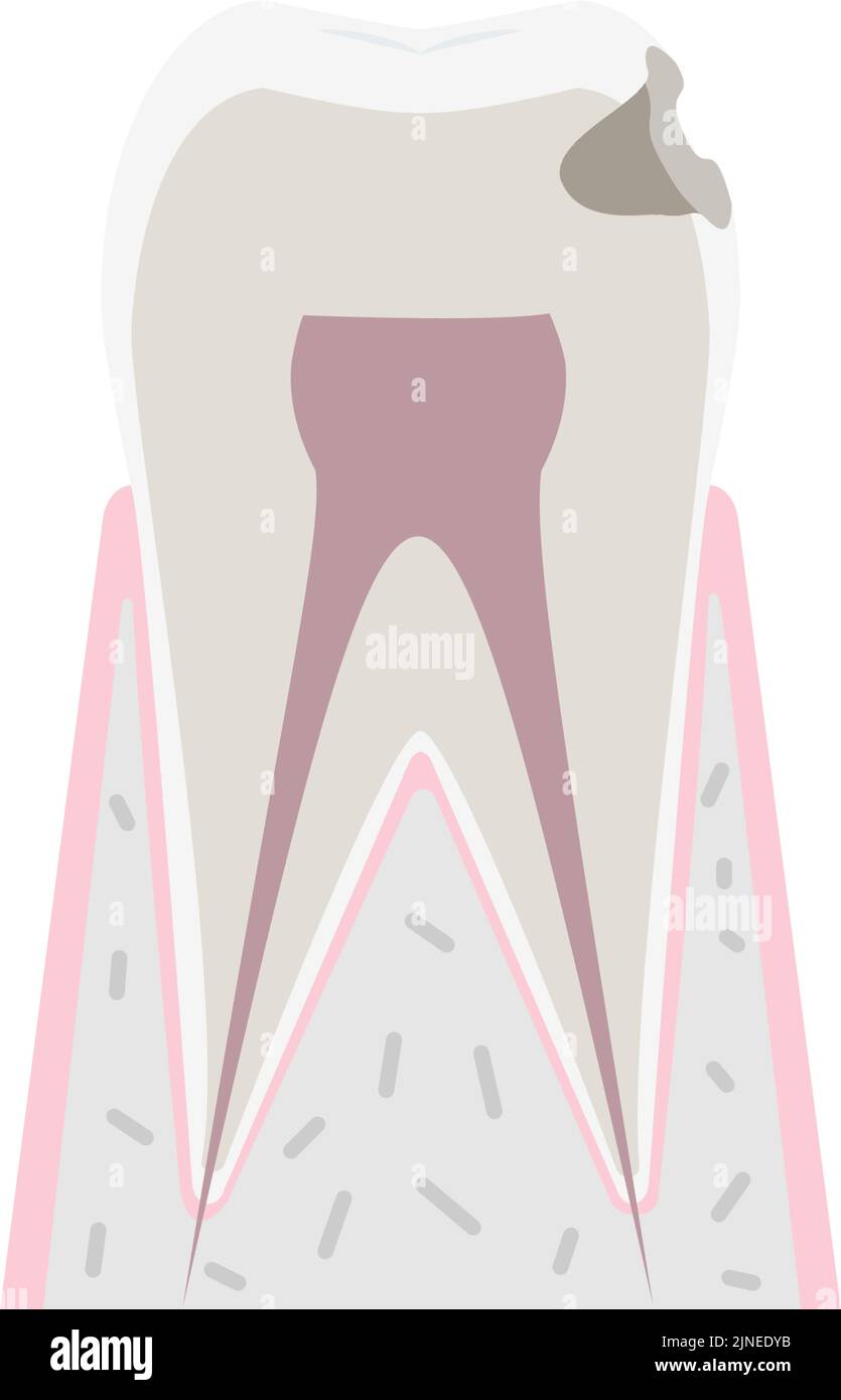 Progrès de caries, caries atteignent dentine Illustration de Vecteur