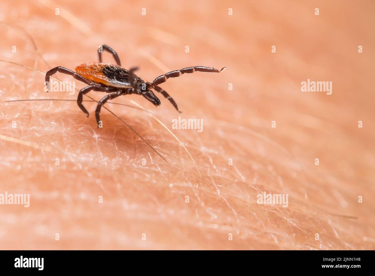 Gros plan de la tique parasite de la course sur la peau humaine texturée. Ixodes ricinus. Parasite d'insecte dangereux en mouvement dynamique. Encéphalite, maladie de Lyme. Banque D'Images