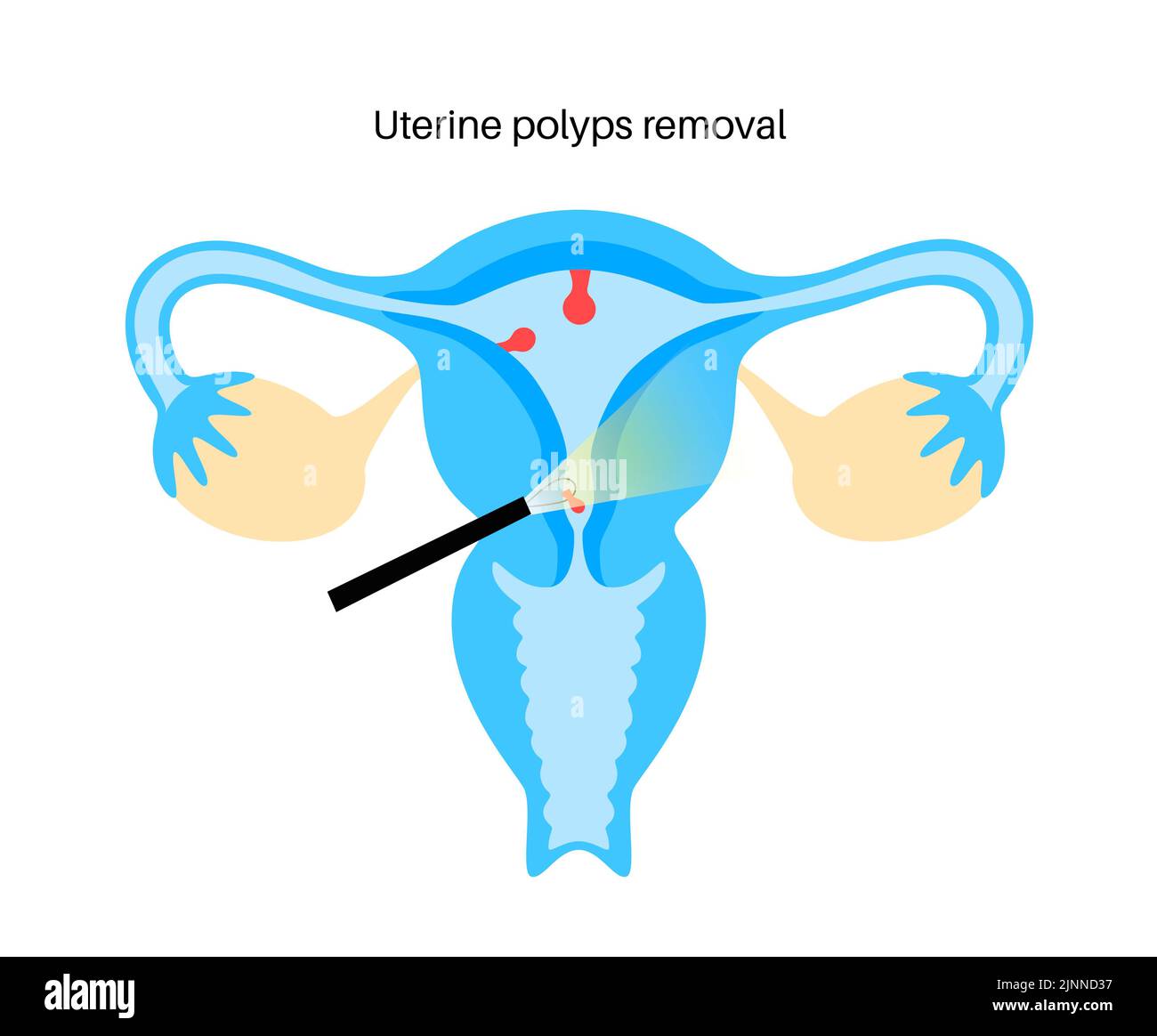 Polypes utérins, illustration Banque D'Images