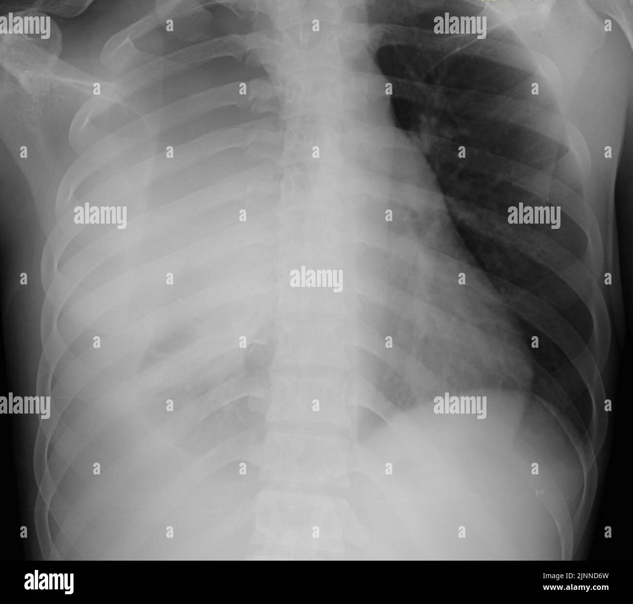 Épanchement pleural, rayons X. Banque D'Images