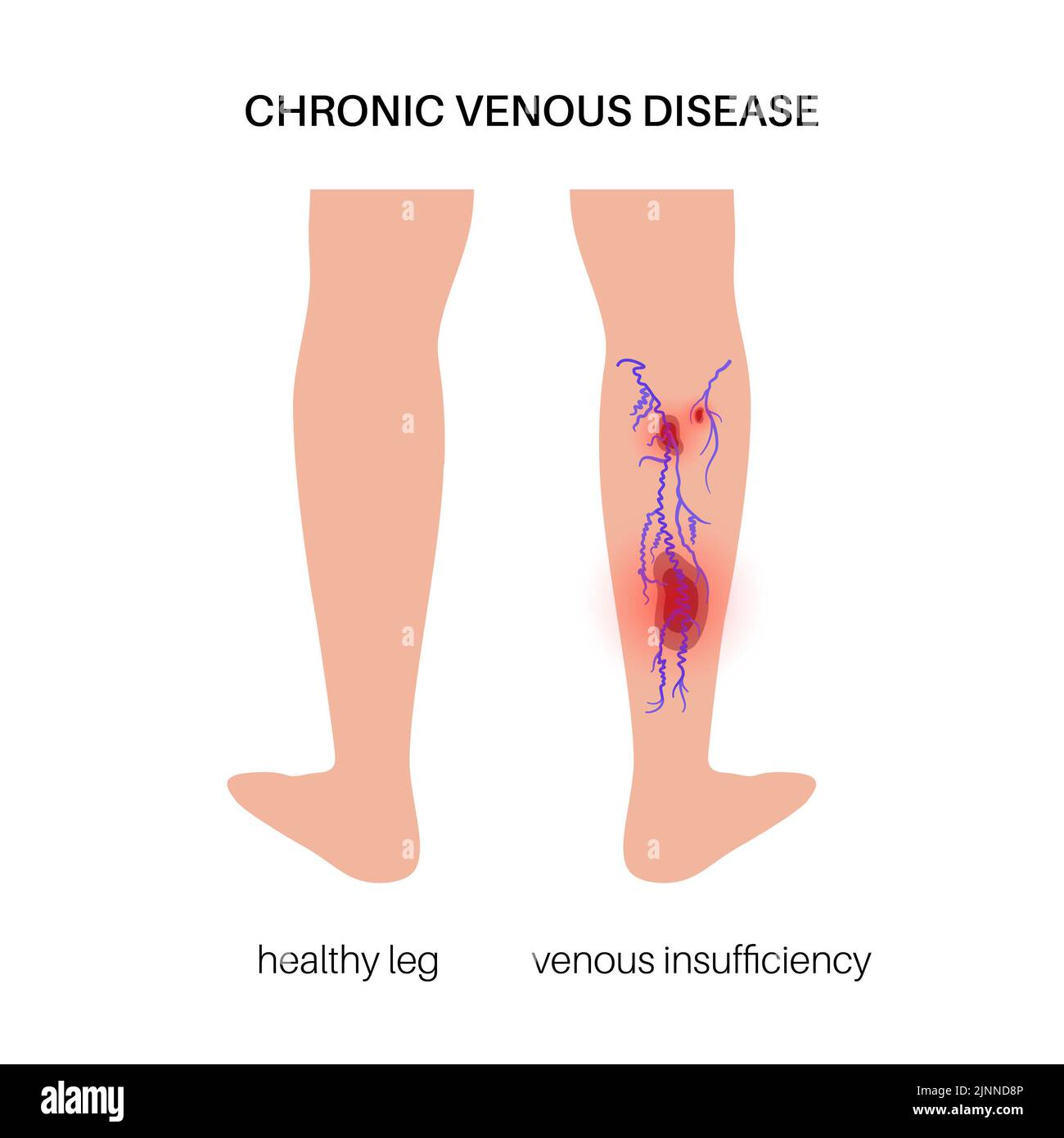 Insuffisance veineuse, illustration Banque D'Images