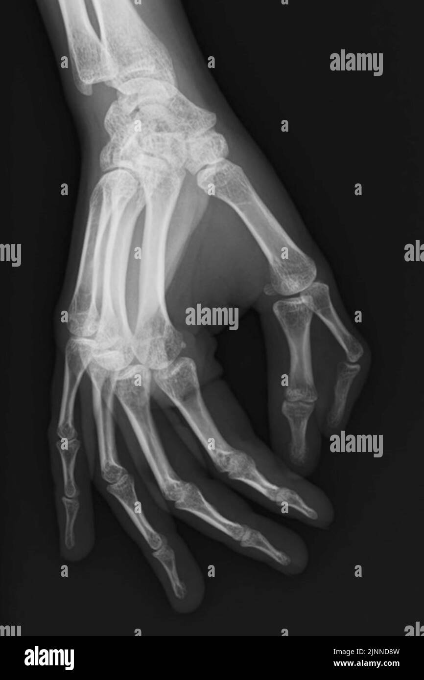 Main polydactylie, rayons X. Banque D'Images