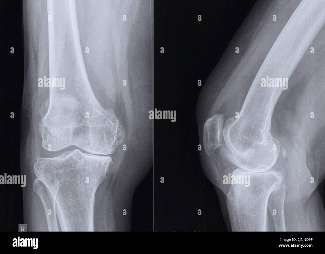Arthrose du genou, acquisitions par rayons X. Banque D'Images