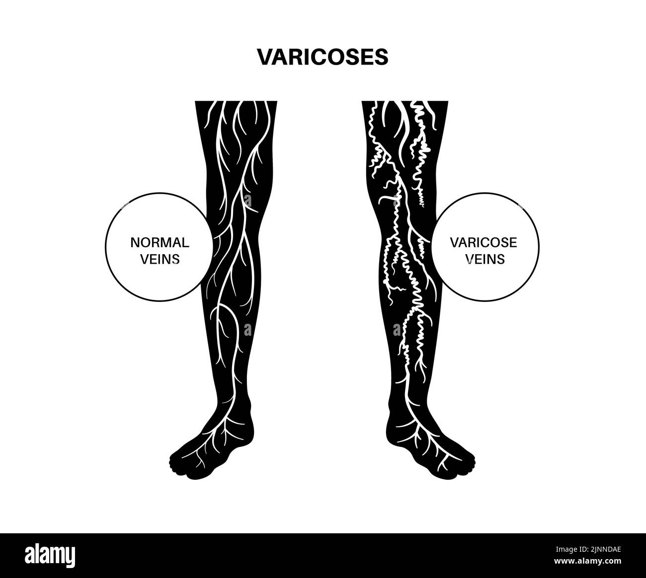 Varices, illustration Banque D'Images