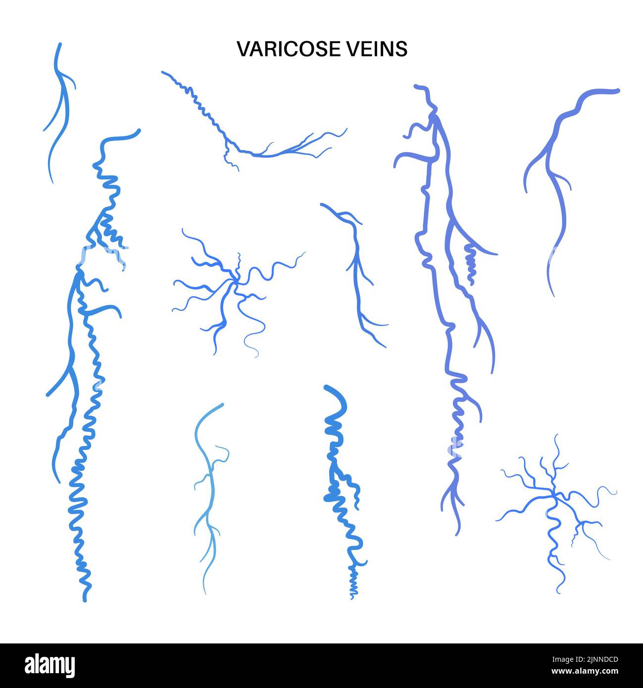 Varices, illustration Banque D'Images