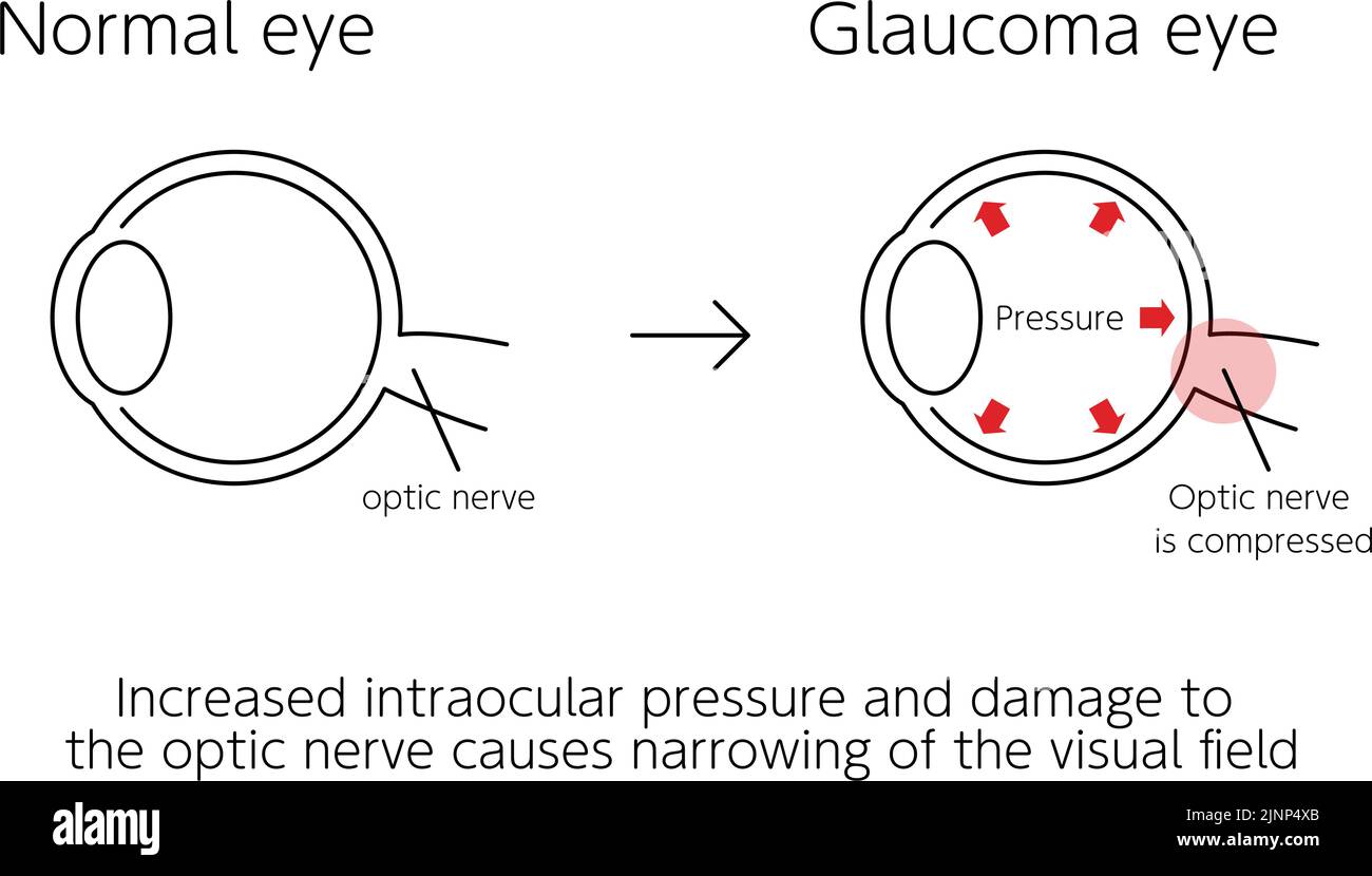 Illustration du fonctionnement du glaucome, yeux normaux et glaucomateux, illustration médicale Illustration de Vecteur