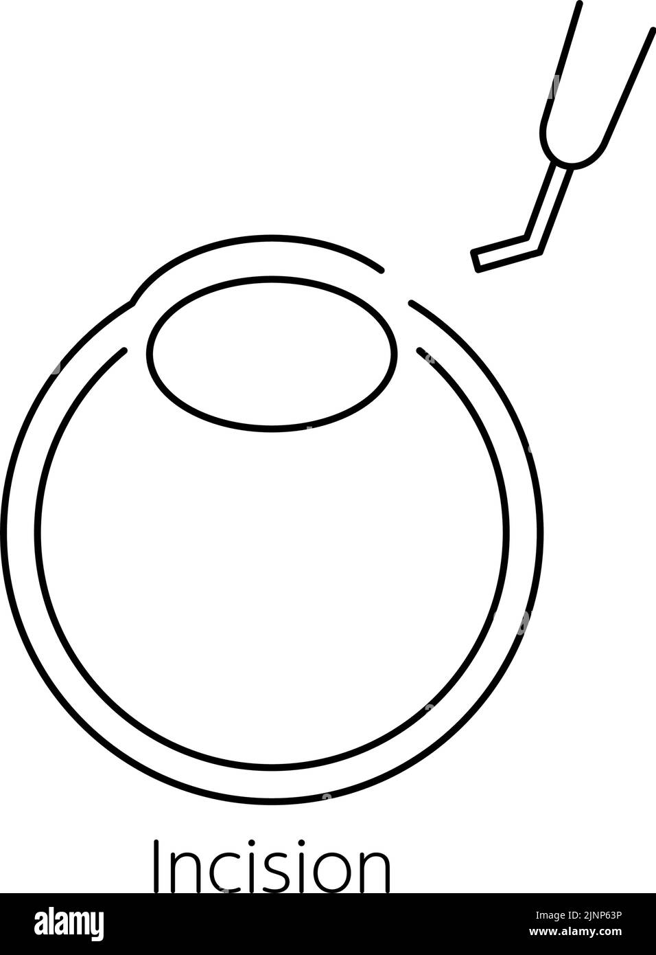 Processus de chirurgie de la cataracte, Illustration (dessin de ligne), faire une incision Illustration de Vecteur