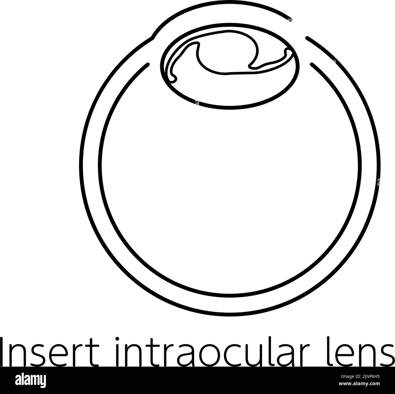 Flux de chirurgie de la cataracte, illustration (dessin de ligne), Insertion d'une lentille intraoculaire Illustration de Vecteur