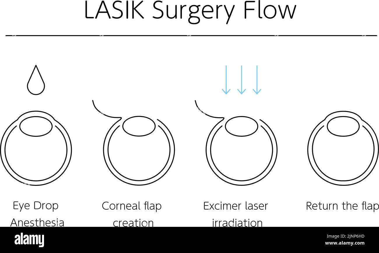 Illustration médicale de la LASIK et de la chirurgie réfractive Illustration de Vecteur
