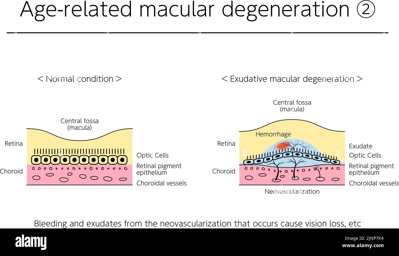 Maladies oculaires, dégénérescence maculaire exsudative liée à l'âge illustrée Illustration de Vecteur
