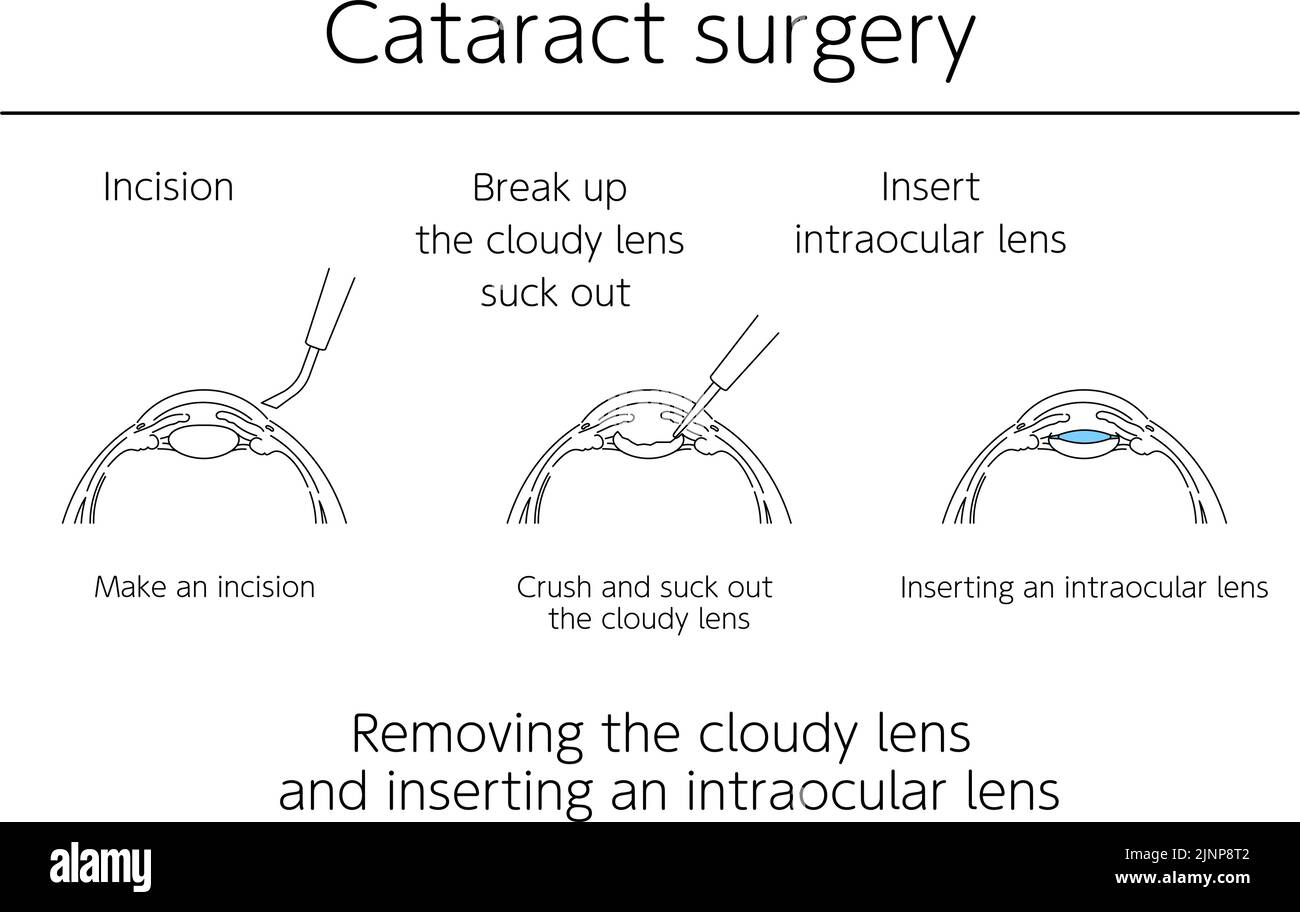 Illustrations, chirurgie de la cataracte, illustrations médicales. Illustration de Vecteur