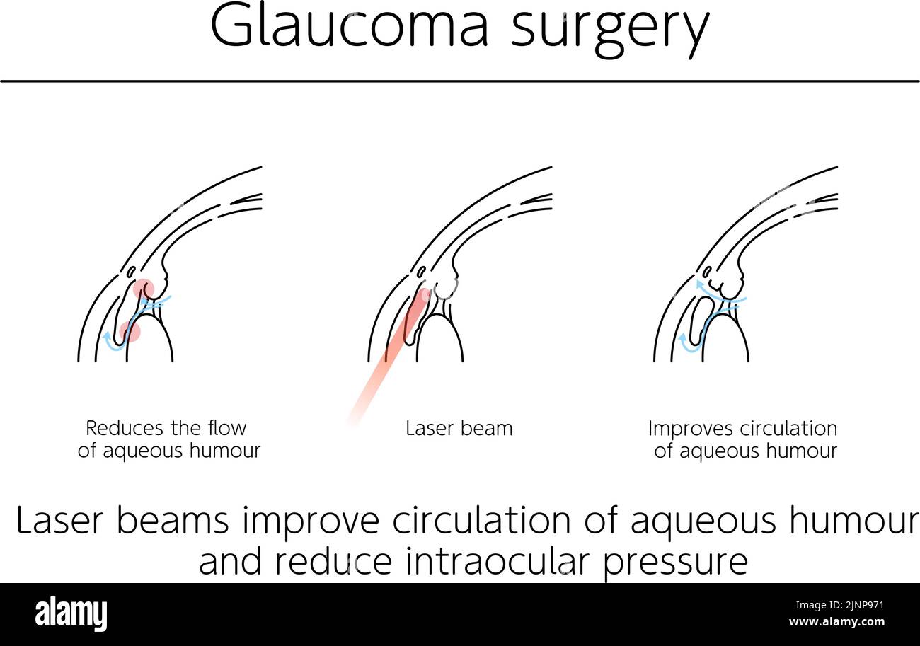 Illustrations, chirurgie du glaucome, illustrations médicales. Illustration de Vecteur