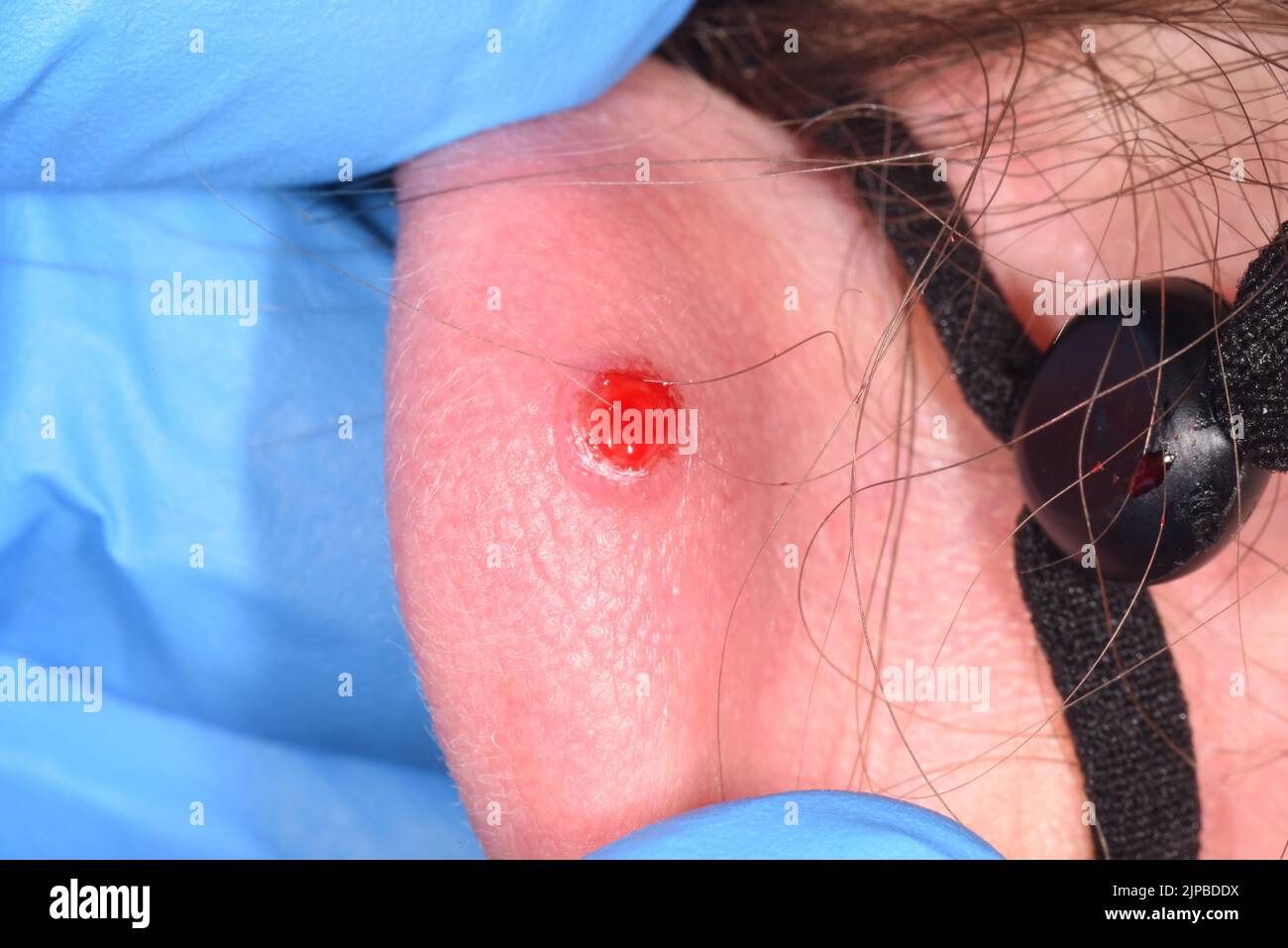 Piercing d'oreilles infecté Banque D'Images