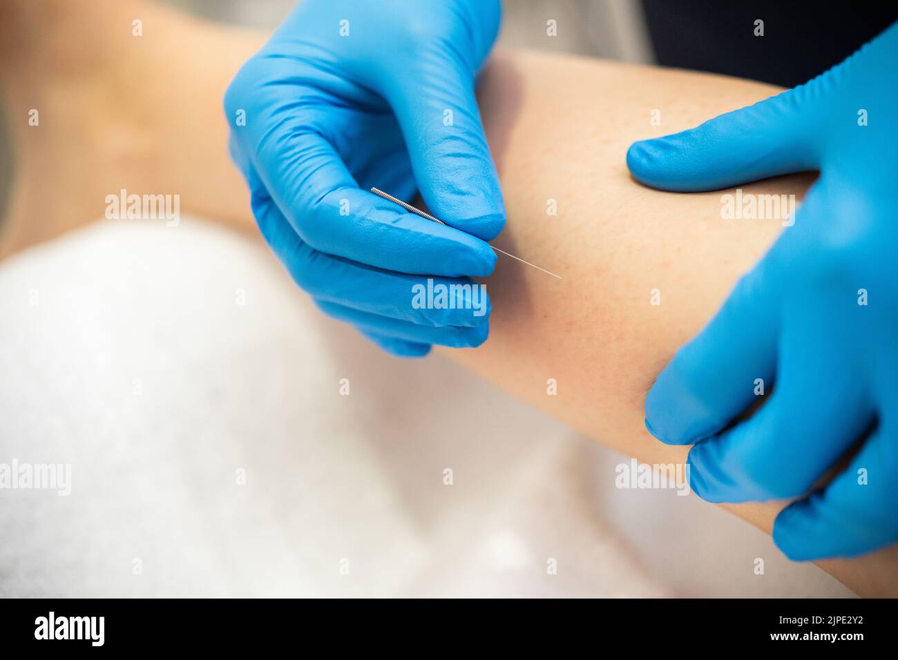 Mains de physiothérapeute faisant un aiguillage sec Banque D'Images